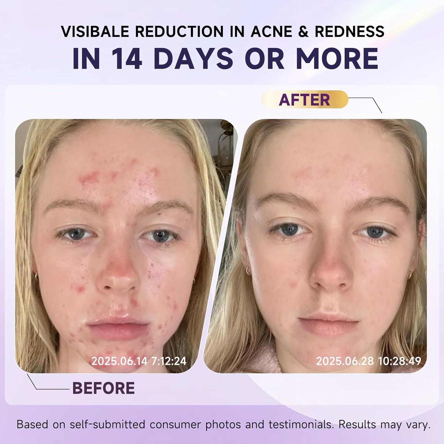 10% Azelaic Acid Acne Treatment – Hormonal Breakout & Cystic Acne Cream for Face | Redness Reduction & Moisture for Sensitive, Rosacea-Prone Skin – 1.7 oz