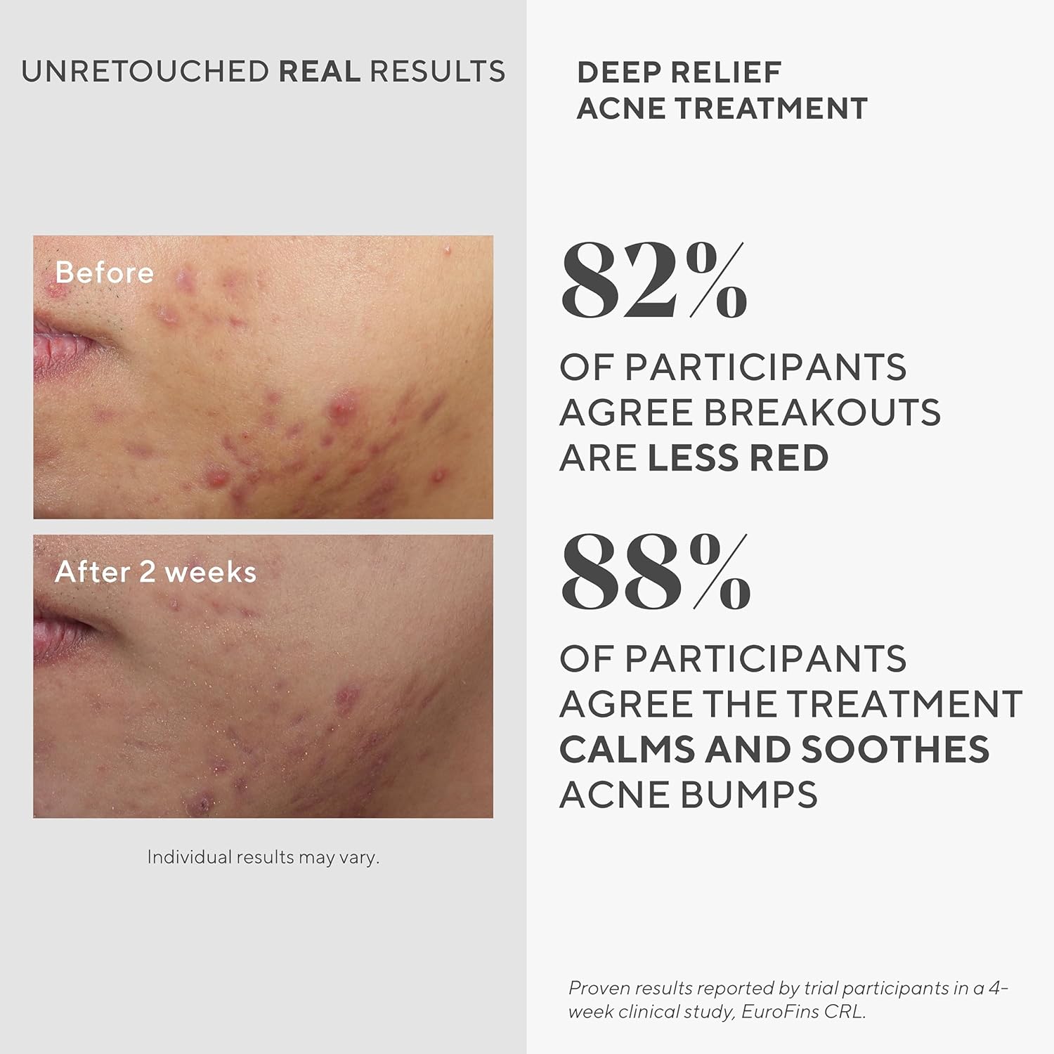 Murad Resurfacing Treatment: 2% Salicylic Acid Acne Spot & Redness Relief Serum