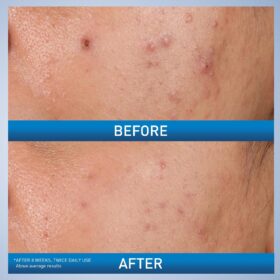 CeraVe Acne Control Gel with 2% Salicylic Acid | Oil-Free Face Treatment with Ceramides, Niacinamide & AHA/BHA for Pore Minimizing and Hydrating Acne Relief, 1.35 Fl Oz